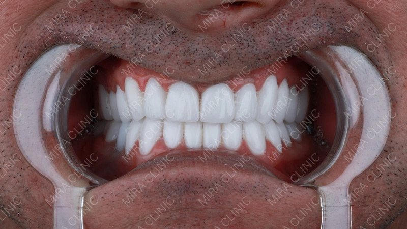 Porcelain Veneers